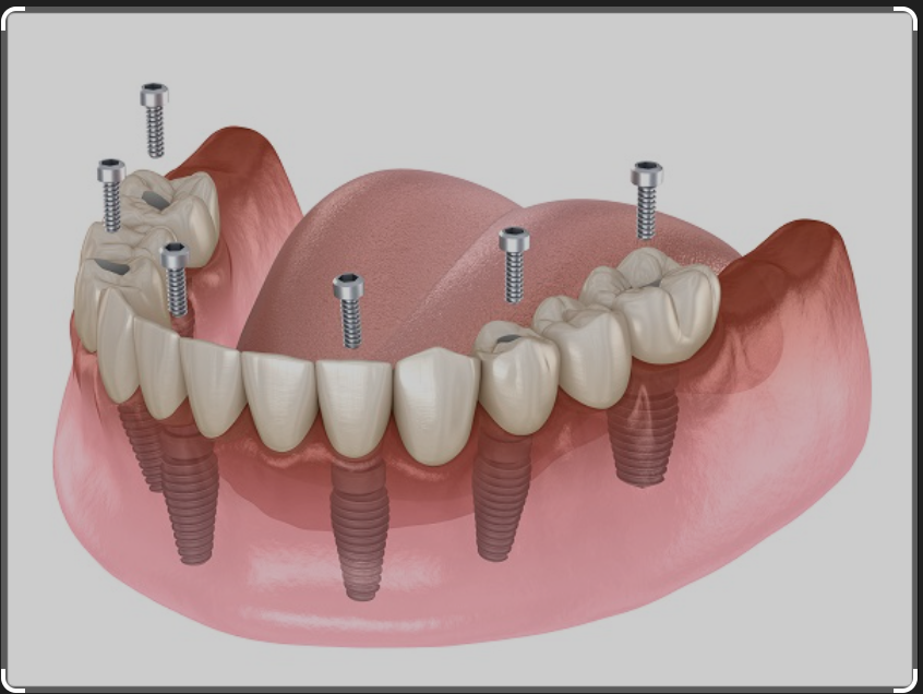 bridge complet sur implants